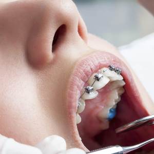 About Braces About Braces